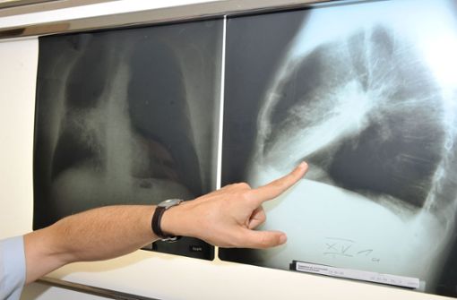 Ein Arzt zeigt auf ein Röntgenbild einer von Krebs befallenen Lunge. Foto: Felix Hörhager/dpa/Felix Hörhager